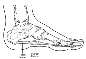 plantar fibroma