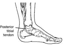 posterior tibial tendonitis posterior tibial tendonitis