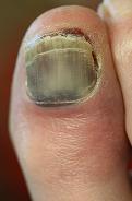 subungual hematoma black toenail