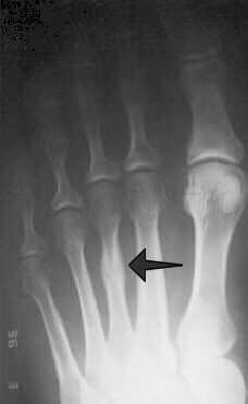 third metatarsal stress fracture