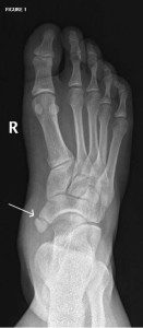 accessory navicular bone