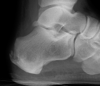 calcaneal spur xray