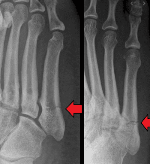 Jones Fractures Foot & Ankle