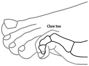 Claw toe