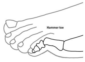 hammer toe