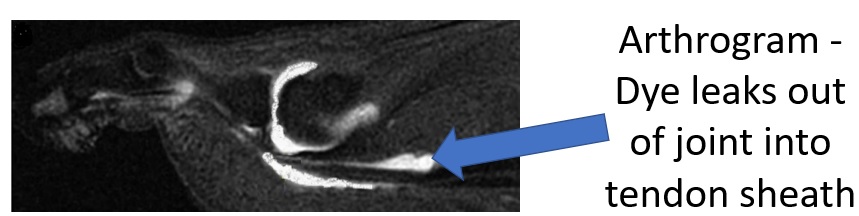 MRI plantar plate tear