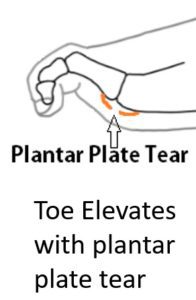 Plantar plate tear