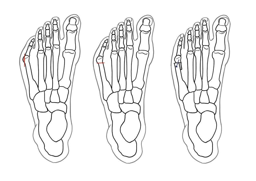 Tailor's bunion surgery