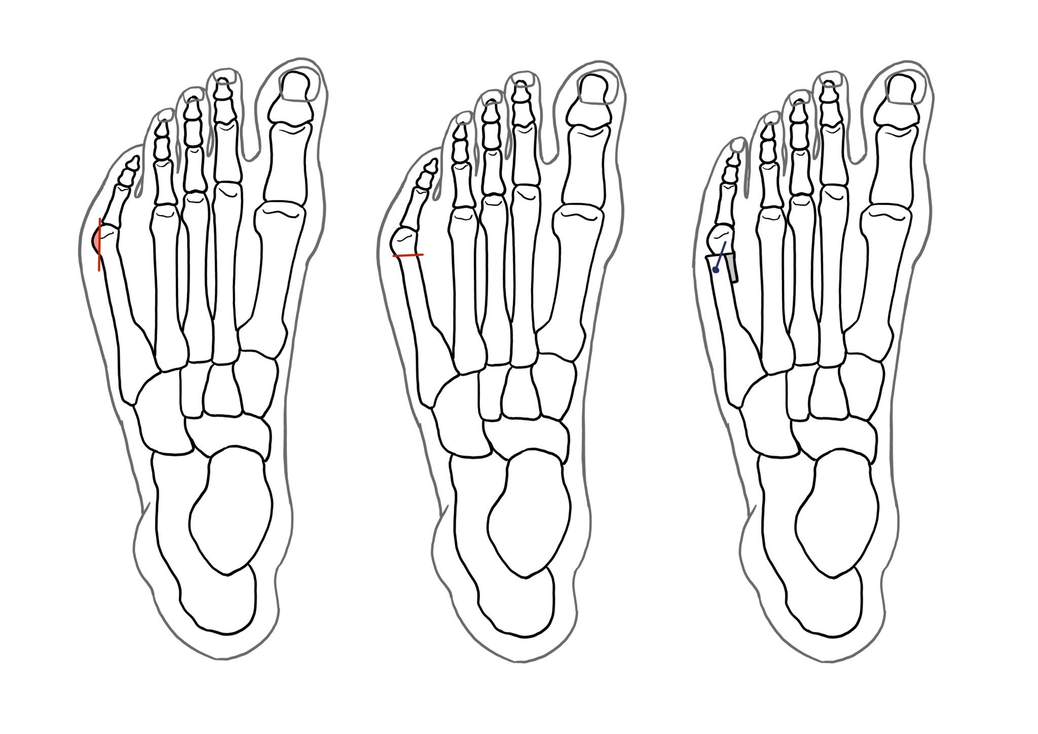 Tailor’s Bunion Surgery A Complete Guide Foot & Ankle