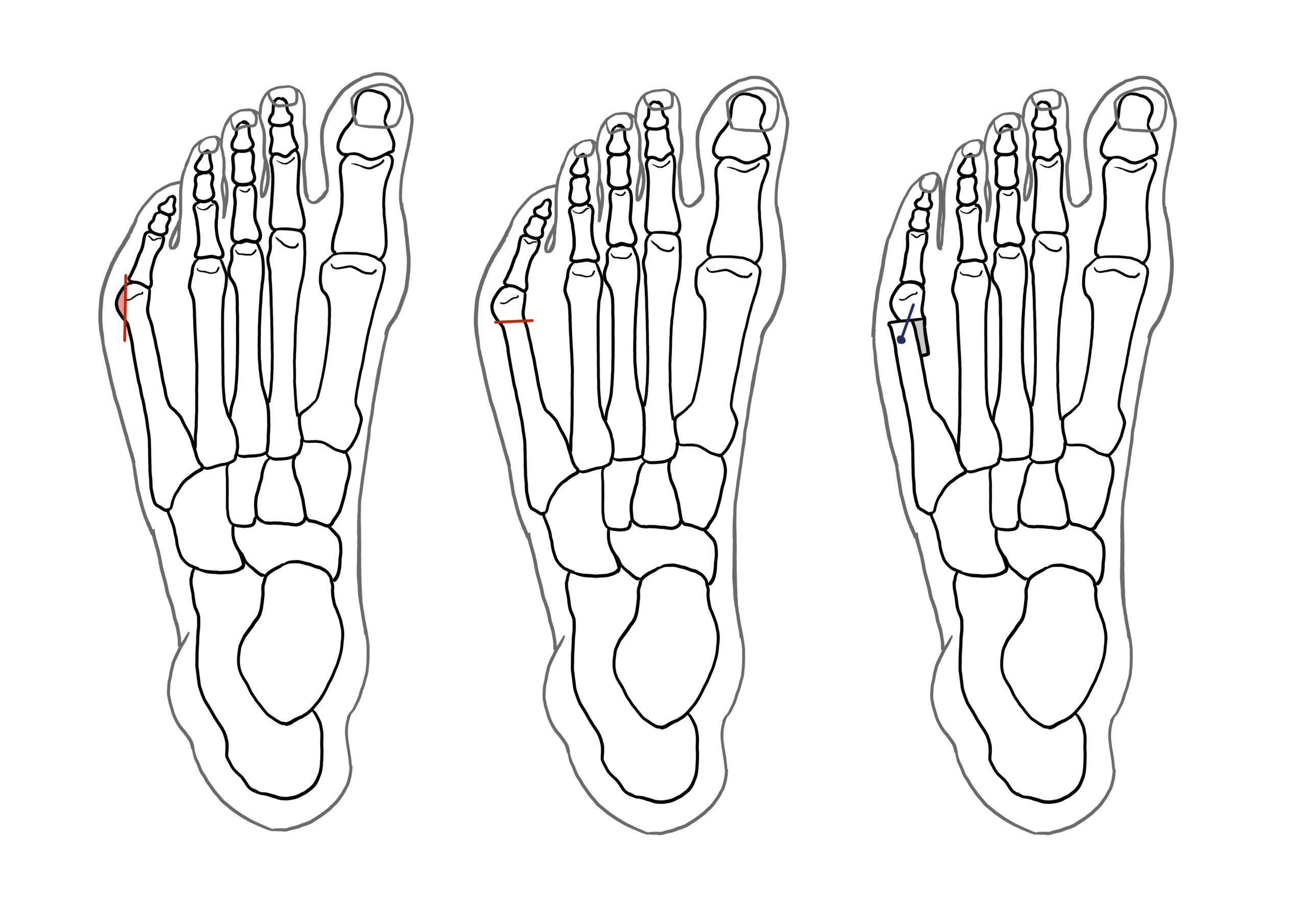 Tailor's Bunion Surgery A Complete Guide Foot & Ankle