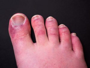 chilblains affecting the toes
